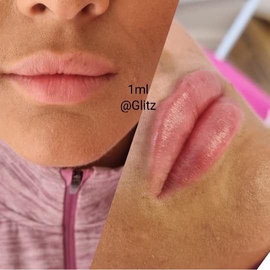 1ml lip filler before and after at Glitz Belfast